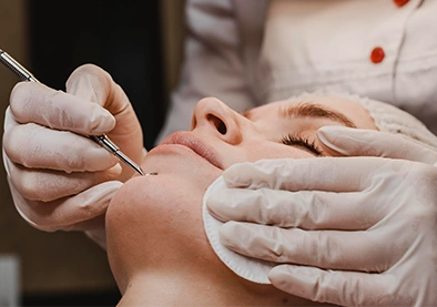 acne scars control