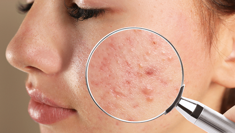 acne cotrol