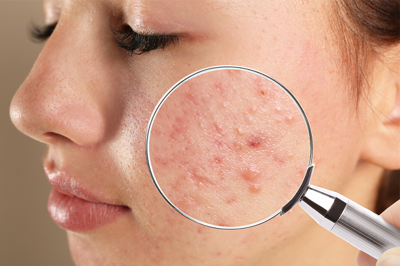 acne cotrol